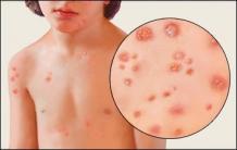 Chickenpox Causes, Symptoms, remedies and Ayurvedic Treatment