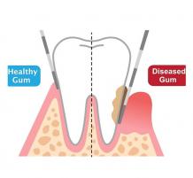 Gum Disease Treatment In Melbourne