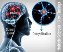  Chronic Cerebro Spinal Venous Insufficiency Treatment in India