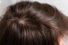 How to cure dandruff permanently: 4 Tips &amp; Tricks