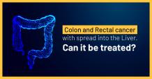 Colon &amp; Rectal Cancer with Liver Metastasis - Treatment, Diagnosis &amp; Side Effects