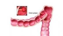 Colon Polyps Dubai - Dr. Muharrem Öner