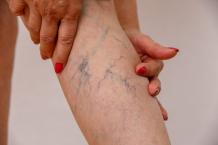 Veintreatmentli | How to Figure Out That Varicose Vein Treatment is Suitable for You?