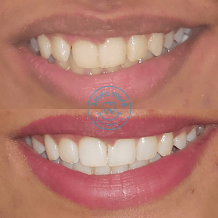 Cosmetic dentist in Mumbai - Cost of cosmetic dentistry - Smile Store