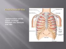 Costochondritis Symptoms, Treatment – Natural Herbal Product