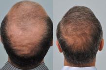  Crown Hair Transplant AT Hair Transplant Dubai Clinic - Best Hair Transplantation Dubai 