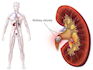 Kidney Stones: What are Your Treatment Options?