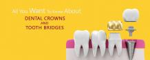 Know About Dental Crowns and Tooth Bridges | Tooth Cap Price In Pune