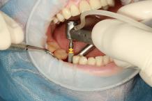 dental-implant-care