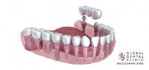 Dental Implant in Ahmedabad | Cost of Implant - Global Dental Clinic