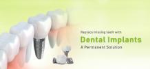 dental implants in mumbai