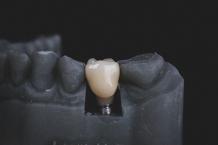 dental implants san antonio