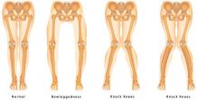 Development of Angular Deformities 