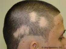 Alopecia Treatment, Diagnosis, Causes Of Alopecia, Symptoms - Herbs Solutions By Nature Blog