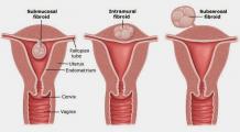 Fibroid Surgery Cost in delhi	