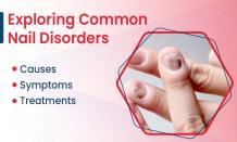 Exploring Common Nail Disorders: Causes, Symptoms, and Treatments - Kalpit Healthcare