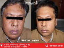 #No1 Double Chin Reduction Treatment in Durgapur