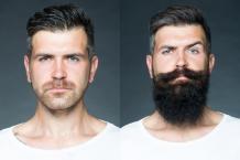 Can you grow a Beard with applications of Rogaine? &#8211; Hair Transplant Clinic Dubai