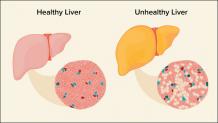 Ayurvedic Treatment for Fatty Liver Cure