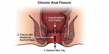 Fissure Treatment in Indore, Anal Fissure Treatment in Indore | Dr Nilesh Dehariya