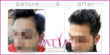 FUE Hair Transplant Clinic, Cheap Fue treatment cost in Delhi, India