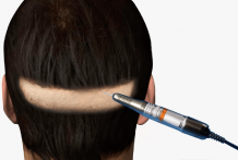 Cheap FUE clinic, fue Hair Transplant treatment cost in Delhi India