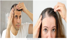 FUE Hair Transplant in Hyderabad-View Cost | Redefine Hair Transplant &amp; Plastic Surgery Centre