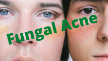 Fungal Acne: Symptoms, Causes, Diagnose, Treatment, Diet,