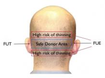 Hair Transplant in Delhi | Hair Transplant Cost in Delhi NCR