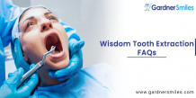 Wisdom Tooth Extraction FAQs