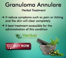 Best Way to Treat Granuloma Annulare Naturally at Home - Herbal Care Products