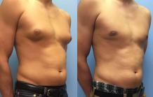 Top Gynecomastia Surgery in Pune, PCMC - Dr. Shilpy Dolas