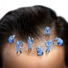 Hair Restoration in Delhi | Hair Transplant Surgery in Delhi