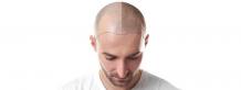 What Everyone Must Know About Hair Replacement | Hair Transplant Dubai