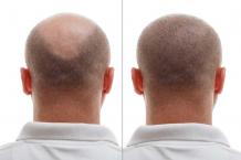 Hair Transplant Doctor in Delhi