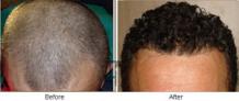 Dandruff after Hair Transplant Affect Hair Growth?  | Hair Transplant Dubai