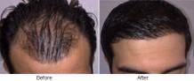 No Shedding after Hair Transplant | Hair Transplant Dubai