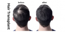 How do you get benefits from a hair transplant before and after?