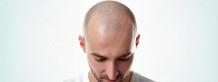 The Art of Grafts Placement in Hair Transplantation | Hair Transplant Dubai