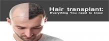 Everything You Need to Know About Hair Transplants | Hair Transplant Dubai