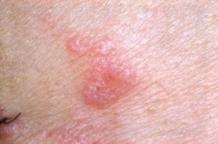 Herbal Treatment for Lichen Planus and Its Promising Solution - Herbal Care Products - Blog