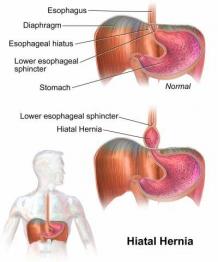 Hiatal Hernia Dubai 