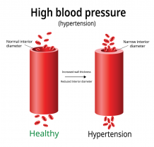 High Blood Pressure: Symptoms and Treatment