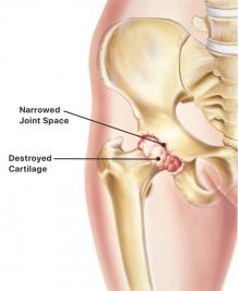 hip replacement surgery in vadodara