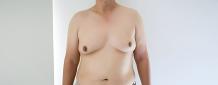 How do you know if you have Gynecomastia?