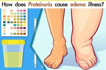 How Does Proteinuria Cause Edema Illness?