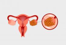 How Fibroids Affect Fertility and Pregnancy