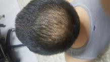 How Long After Hair Transplant Will Grafts be Secure? | Hair Transplant Dubai