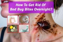 How To Get Rid Of Bed Bug Bites Overnight?