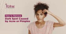 How to Remove Dark Spot Caused by Acne or Pimples - Skin Solutionz
